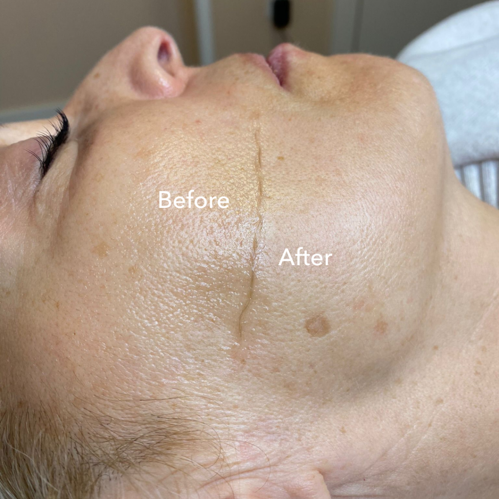 Before and after comparison along a client's cheek and jaw after dermaplaning
