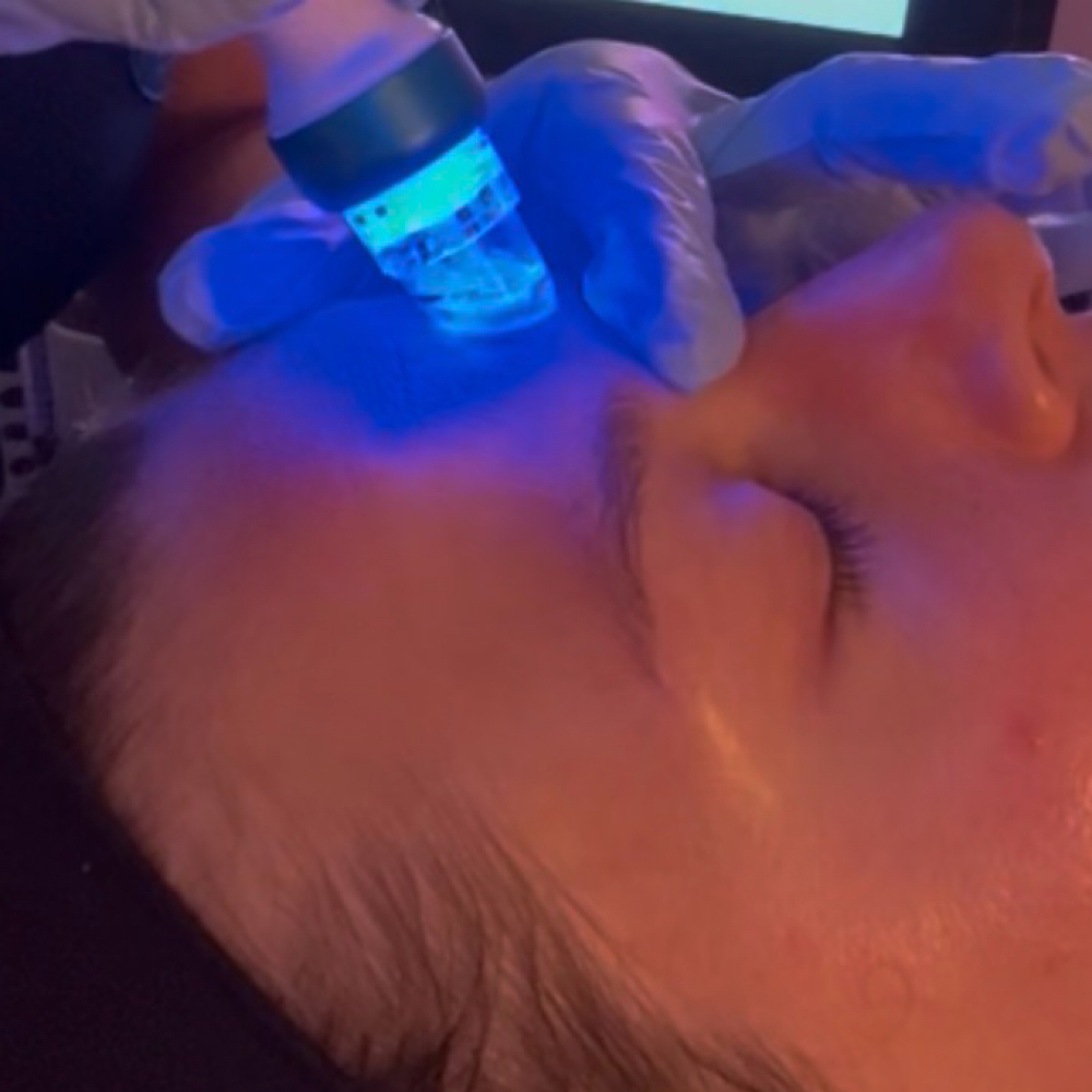 Blue LED handpiece passing over a client's cheek in a darkened room