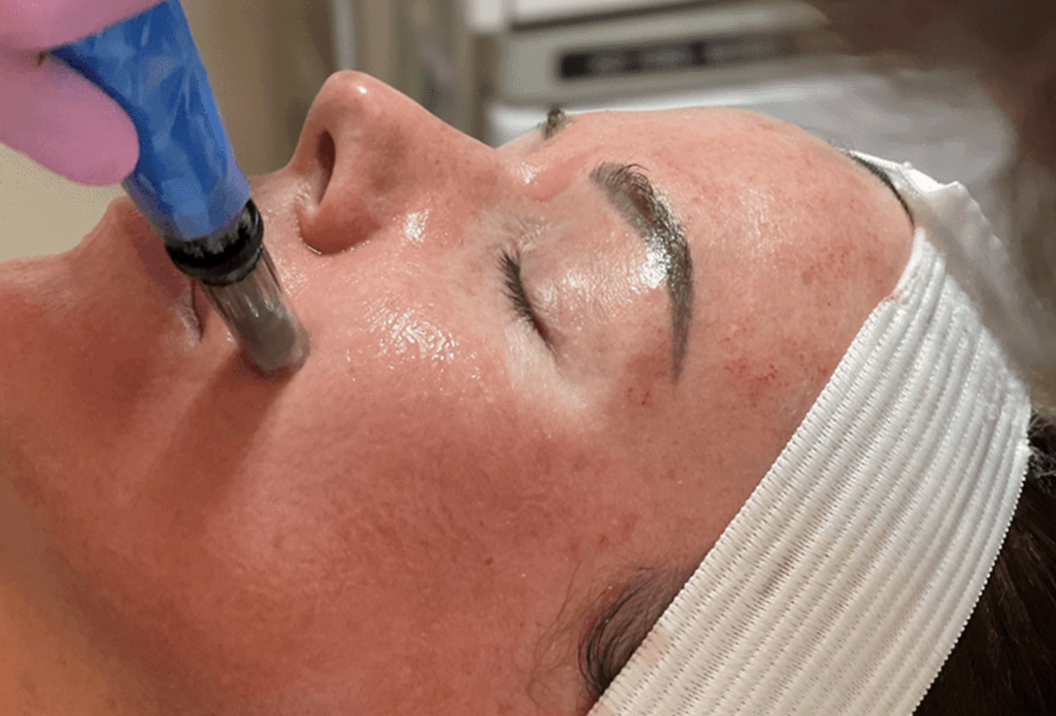 Blue microneedling pen working in short passes above a client's brow